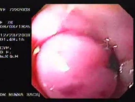 Hemorrhage due status post rubber band ligation of esophageal varices (25 of 25)