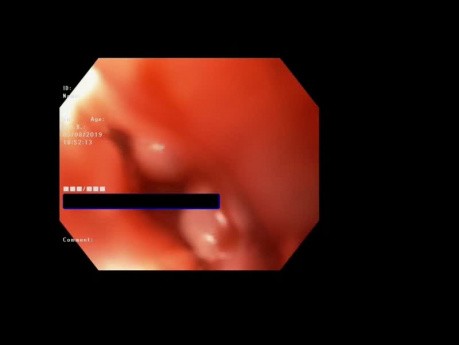 Buried Mega Stent Rescue