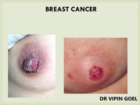Warning Signs of Cancer? How to Diagnose Cancer Early (7 Symptoms One Should Know)