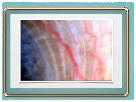 Glaucoma and lymphatics surgery