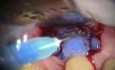 Reparation Of Root Restoration - Periodontal Microsurgery