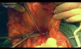 Extended Transverse Colon CME (D3) for Locally Advanced Cancer