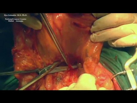 Extended Transverse Colon CME (D3) for Locally Advanced Cancer