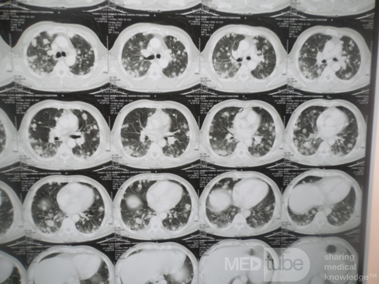 Chest Metastasis Due To Renal Cell Carcinoma 1