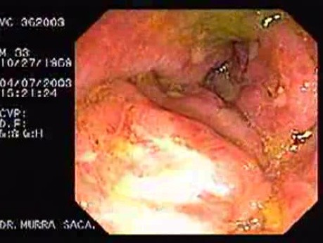 Endoscopic View of Amebiasis Colitis (7 of 7)