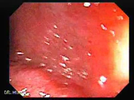Crohn´s Colitis (2 of 3)
