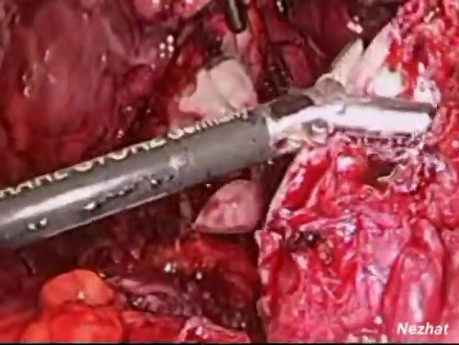 Minimally Invasive Treatment Of Endometriosis In The Intestine