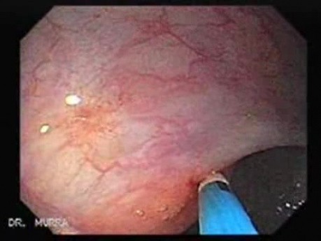Colon Angiodysplasia (14 of 24)