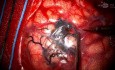 Right Sided Craniotomy and Resection of AVM 