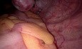vNOTES Salpingectomy Using SILS Port for Ectopic Pregnanacy