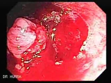 Endoscopic Resection of Giant Tubulo-Villous of the rectum (10 of 35)