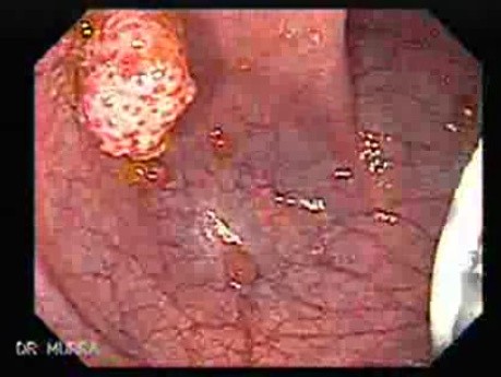 Non Familial Juvenile Polyposis Of The Colon (17 of 37)