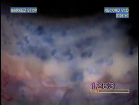 Dye injection- sclero-conjunctival lymphatics
