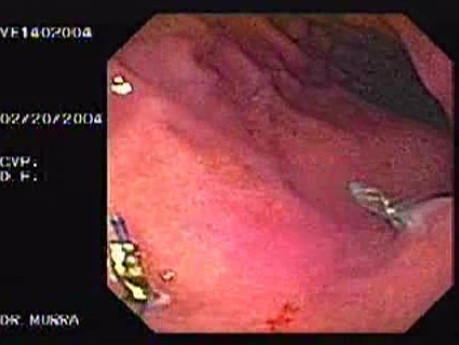 Intraluminal Endoscopic Suturing - Presence of Two Nodules as a Result of Plication
