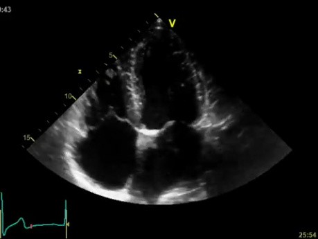 Chronic Kidney Disease as a Main Reason of Aorto-Mitral Valve Calcification