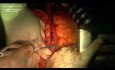 Pylorus Preserving Pancreaticoduodenectomy (Traverso-Longmire Procedure)