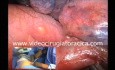Uniportal VAT Left Upper Lobectomy Lung Cancer