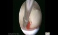 Excision Of Flat Polyp