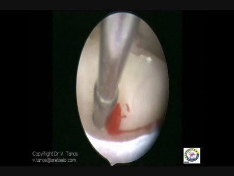 Excision Of Flat Polyp