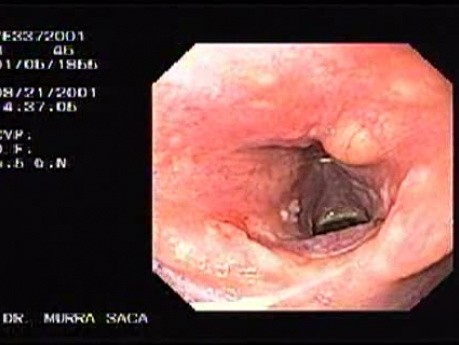 Small papilomas of the larynx