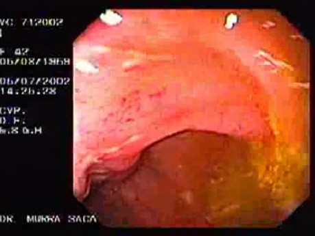 Crohn's Disease - Endoscopy (19 of 28)