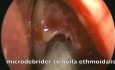 Functional Endoscopic Sinus Surgery - Ethmoid mucocele