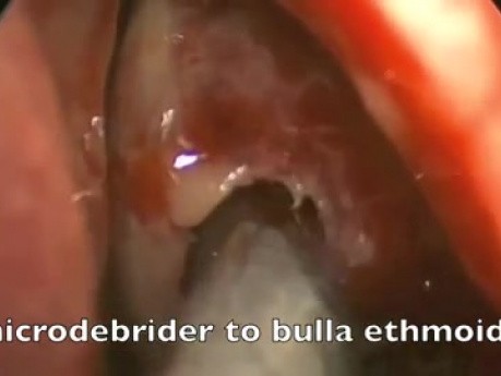 Functional Endoscopic Sinus Surgery - Ethmoid mucocele