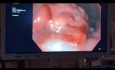 EUS Guided Pancreatic Necrosectomies