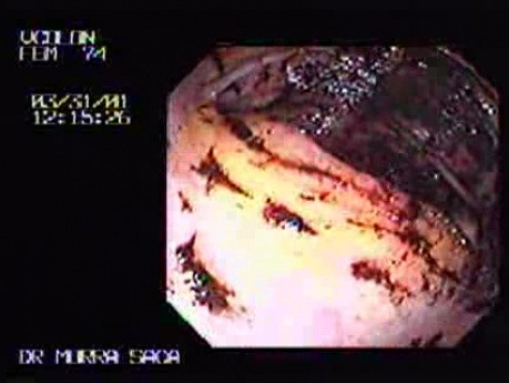 Melena in Colonoscopy
