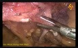 Laparoscopic Right Colectomy with Complete Mesocolic Excision (CATDTP)