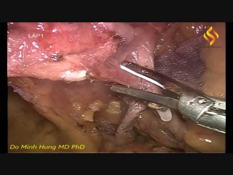 Laparoscopic Right Colectomy with Complete Mesocolic Excision (CATDTP)