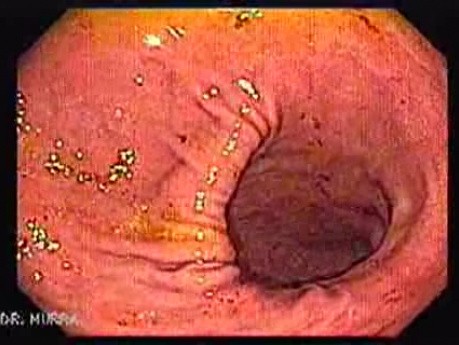 Perystalsis of Stomach