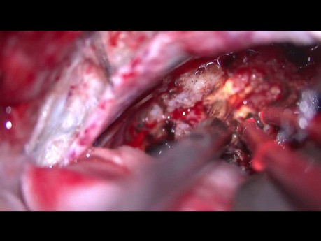 Left Vestibular Schwannoma, Retrosigmoid Approach