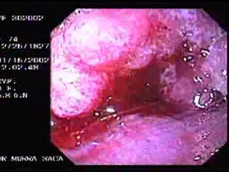 Gastric Adenocarcinoma - Patient With A LargeWeight Loss