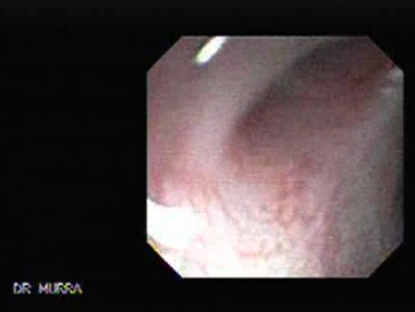 Choledocoduodenostomy and The Sump Syndrome (8 of 10)