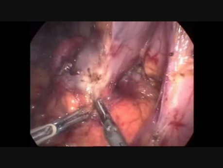 Laparoscopic Resection Of A Duodenal GIST