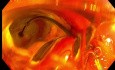 ESD-Assisted Recanalization of a Buried Hepaticojejunostomy