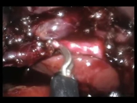 Laparo-Endoscopic Single Site (LESS) Cholecystectomy with Intraoperative Cholangiogram