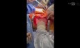 Complex Multi Organ Donation in Patient with Congenital Anomalies