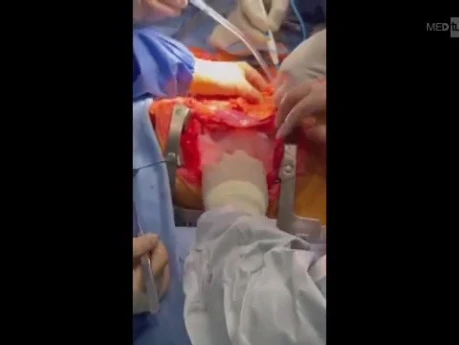 Complex Multi Organ Donation in Patient with Congenital Anomalies
