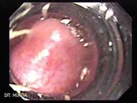Long Standing Alcohol Abuse - Ligation of Esophageal Varix