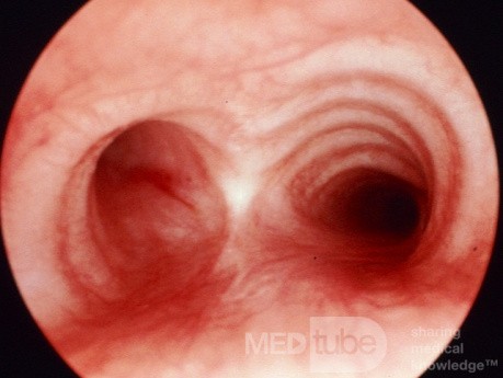 Normal Trachea