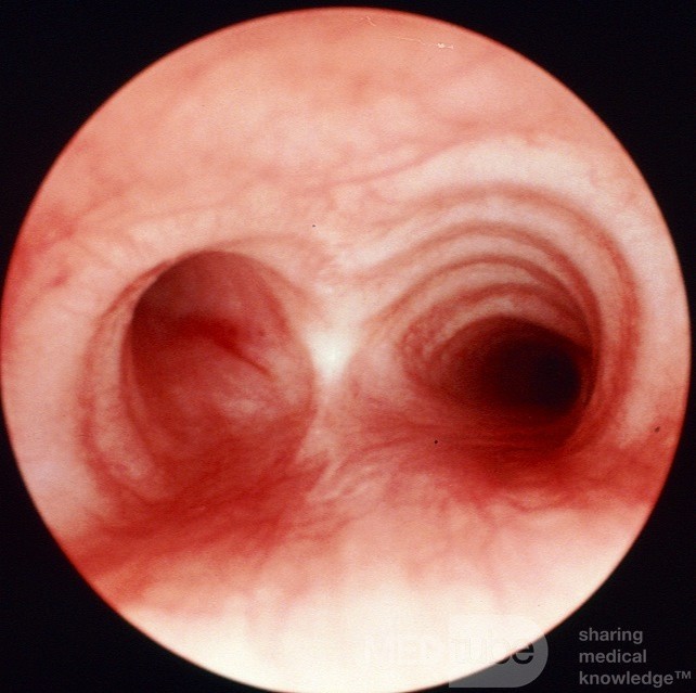 Normal Trachea