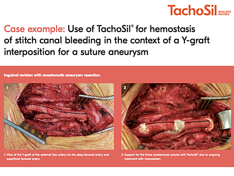 Use of TachoSil® for Efficient Haemostasis and Suture Support in the Case of Stitch Canal Bleedings in Vascular Anastomoses, PD, Arndt Hribaschek