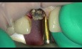 Implant Microsurgery Extraction Technique