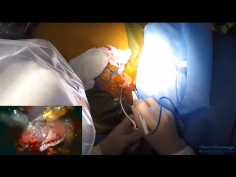 Robotic Transhiatal Esophagectomy