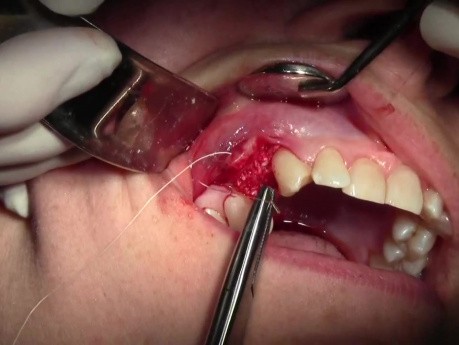 Lateral Ridge Augmentation #5 Site - Mineross And Ora-Mem