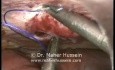 Trocar Site Hernia Repair - Laparoscopy