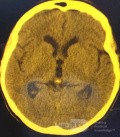 Endoscopic Third Ventriculostomy in a Benign Case of Aicardi Syndrome with Obstructive Hydrocephalus and Chiari Malformation type 1