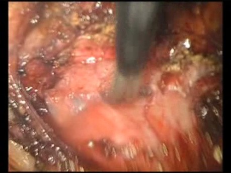 Adhesive Complications in a Patient After Ventral Hernia IPOM Repair - Case 2
